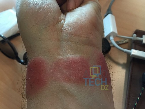 Apple Watch rash or burn1