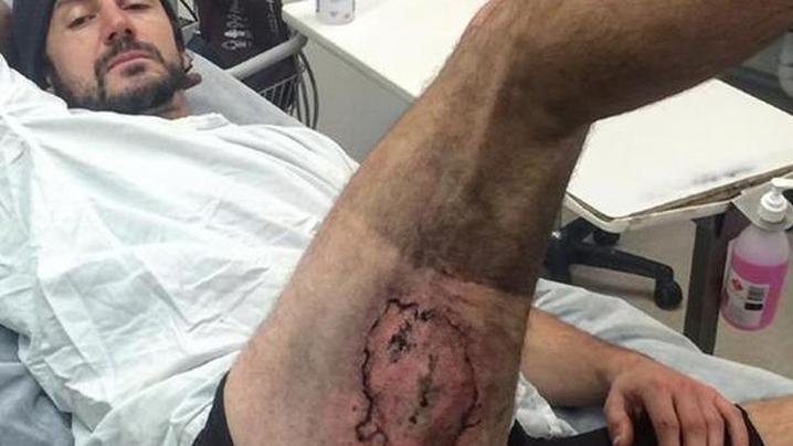 Un australien brûlé au troisième degré par son iPhone 6 2 homme brule troisieme degre par son iphone6 suite une chute